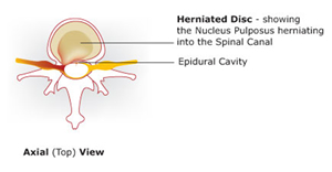 Slipped Disc